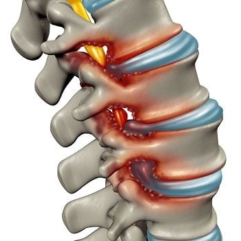 Bei einer Spinalkanalstenose oder auch Wirbelkanalverengung wird speziell bei der Bildung eines Hohlkreuzes starker Druck auf das Rückenmark ausgeübt, was zu starken Schmerzen führt.