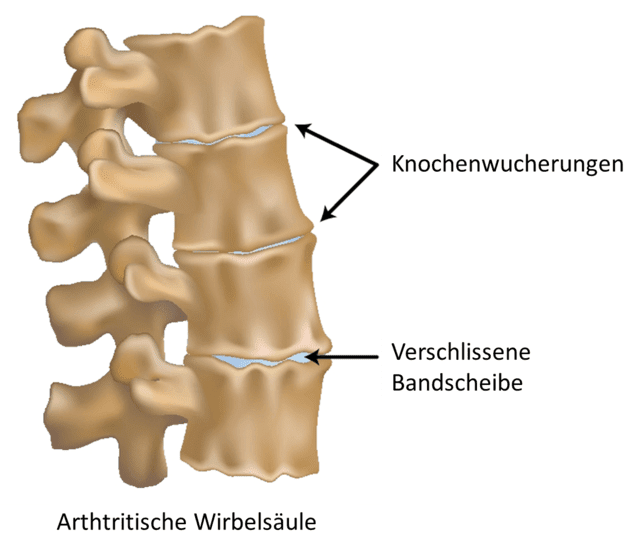 Eine Arthtritis bezeichnet entzündete, schmerzende Gelenke. Im Falle der Wirbelsäule sind die Ober- und Unterseiten der Wirbelkörper und die Facettengelenke betroffen.