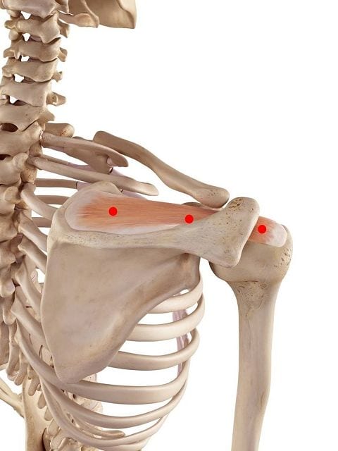 Triggerpunkte im Obergrätenmuskel können neben tiefen bohrenden Schmerzen in den Schultern auch Übertragungsschmerz in den Armen und Bewegungsschmerz bei Überkopfarbeiten führen.