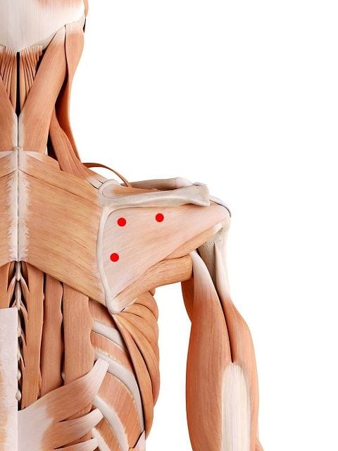 Triggerpunkte im Untergrätenmuskel verursachen heftige Schmerzen in der Schulter sowie eine Schmerzausstrahlung in den Arm. Darüber hinaus können Empfindungssörungen in der Hand auslösen.