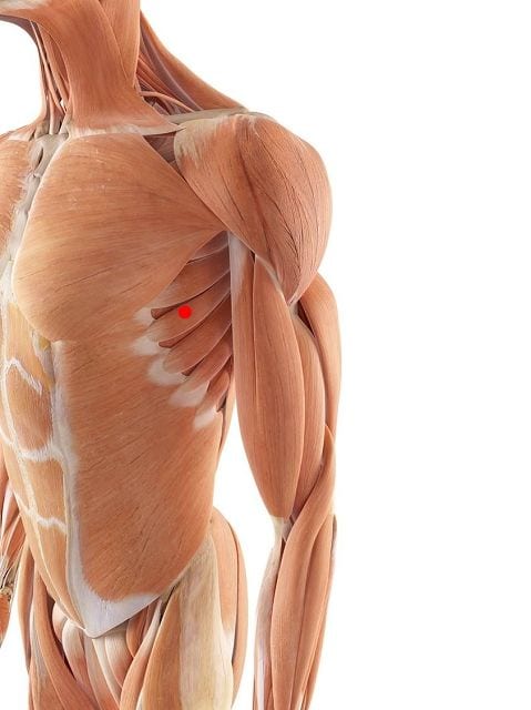 Triggerpunkte im vorderen Sägemuskel verursacht Schmerzen im Schulterblatt, Kurzatmigkeit, Empfindungstörungen im Arm und Bewegngseinschränkungen der Schulter.